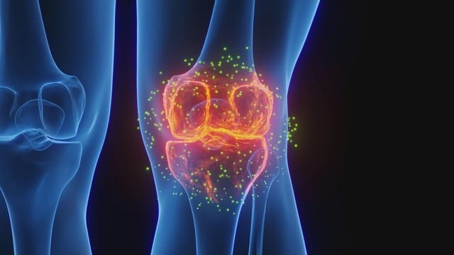 Científicos de Stanford logran regenerar cartílago y revertir la artritis en un estudio innovador