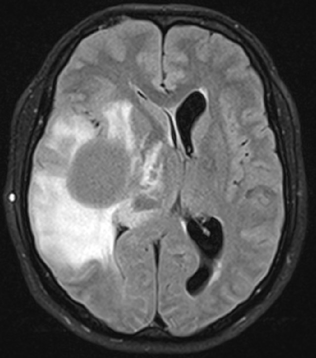 Una vacuna contra tumores cerebrales muestra resultados prometedores a largo plazo