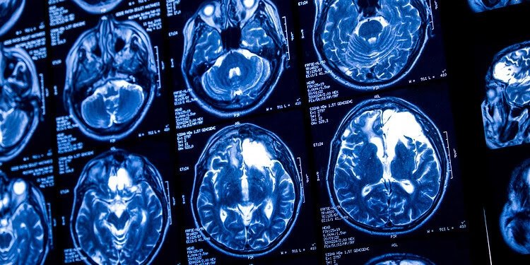 El consumo ligero de alcohol también perjudica la salud cerebral a largo plazo